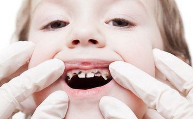 Kẹo ngậm chống sâu răng nào tốt để ngừa sâu răng, viêm lợi cho bé?