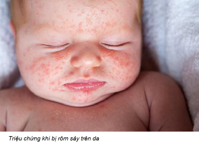 Cách phòng và trị rôm sảy cho trẻ sơ sinh trong mùa hè (1)