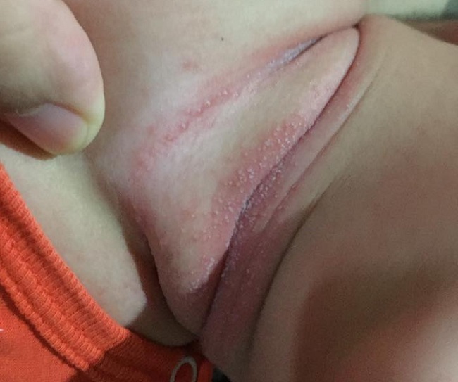 Cách trị hăm da cho trẻ hiệu quả ngay tức thì (1)