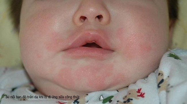 Dị ứng sữa công thức: Nguyên nhân, triệu chứng và biện pháp điều trị (2)