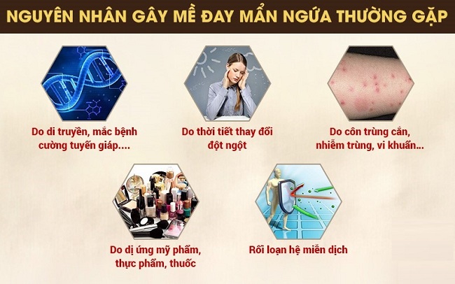 Nổi mề đay sau sinh: Những điều mẹ cần biết (2)