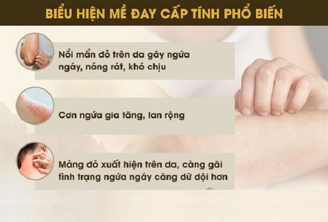 Nổi mề đay sau sinh: Những điều mẹ cần biết (3)