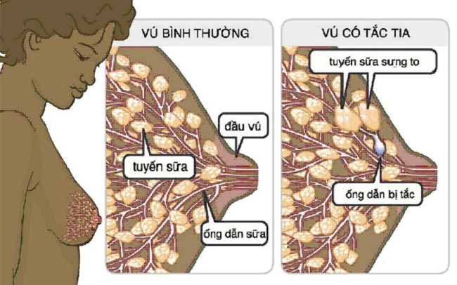 Tắc tia sữa: Nguyên nhân, cách xử trí và phòng tránh cho mẹ (1)